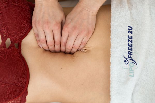 diastasis recti treatment Burton upon Trent