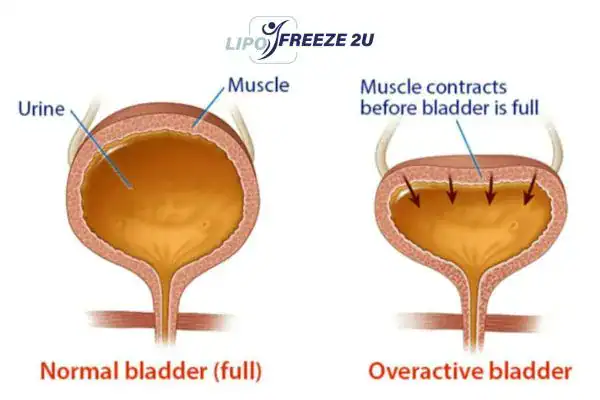 diagram of overactive bladder treatment Burton upon Trent