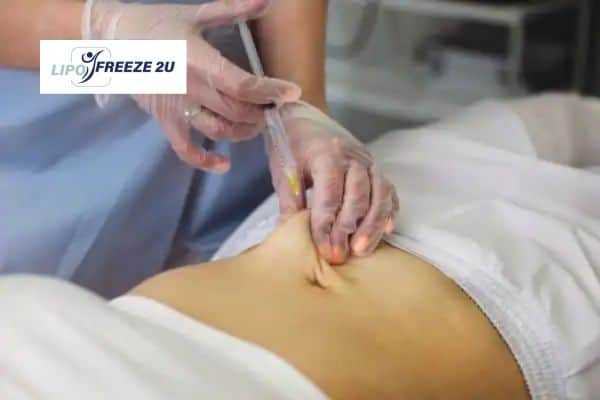 How Does Aqualyx Fat Dissolving Injection Work to Break Down Fat Burton upon Trent?