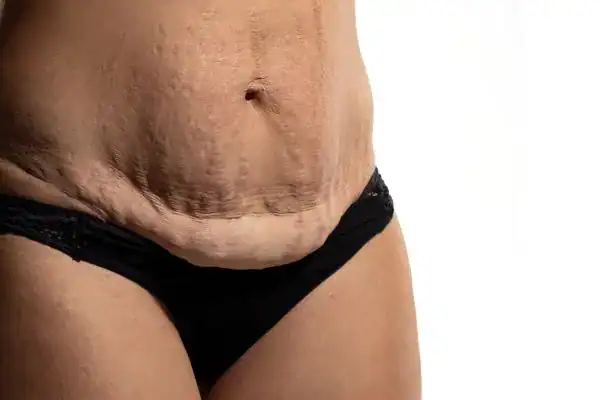 loose skin after weight loss injections Burton upon Trent