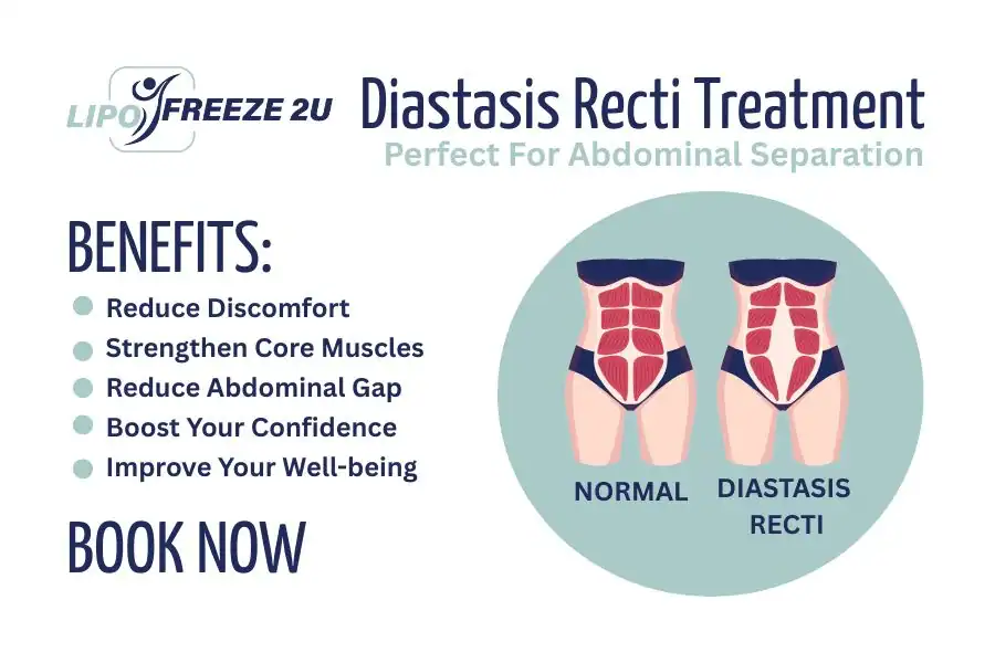 Benefits of body toning treatment Burton upon Trent for Diastasis recti