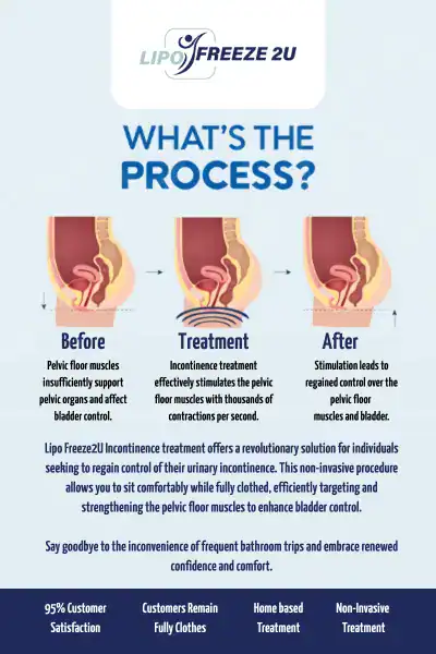 Diagram of how incontinence treatment Burton upon Trent works.