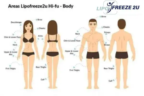 image of areas of the body and HIFU prices Burton upon Trent