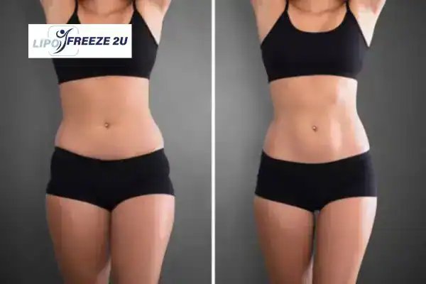How Can LIPO FREEZE 2U Support Your Post-Pregnancy Body Recovery Burton upon Trent?