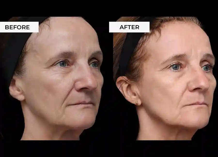 How Many RF Microneedling Sessions Will You Need to See a Difference Burton upon Trent?