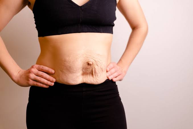 Is Surgery Really the Only Way to Repair Diastasis Recti Burton upon Trent?