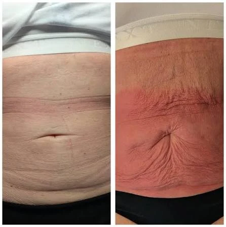How Does RF Microneedling Improve Crepey, Thin and Uneven Skin Texture Burton upon Trent?