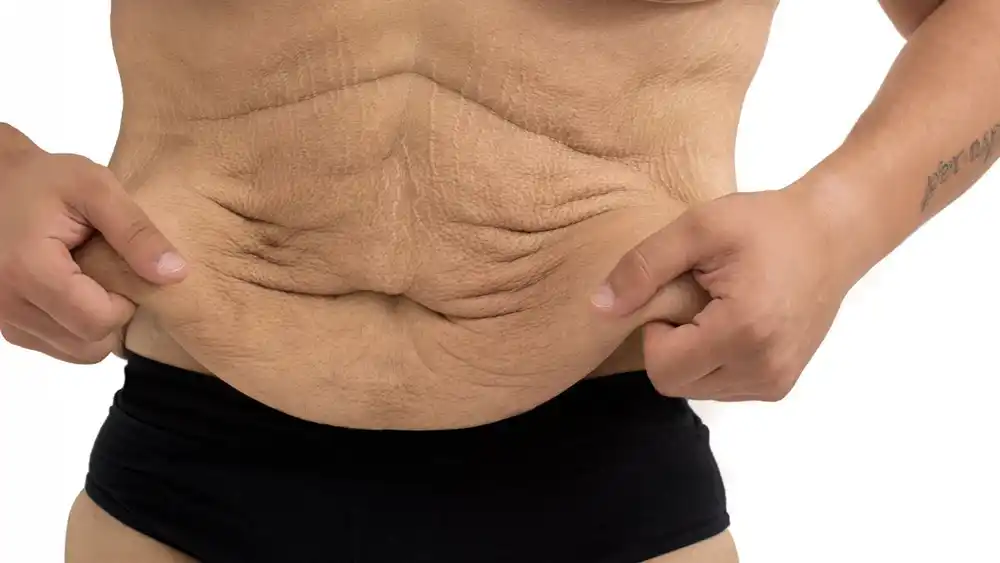 Why Does Weight Loss Medication Leave Some People With Loose or Sagging Skin Burton upon Trent?